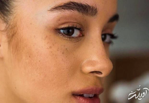 رفع لکه های پوستی